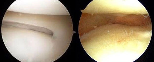 Meniscal-Transplant-Surgery