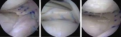 Meniscal-Transplant-Surgery