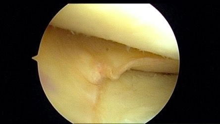 Meniscal-Transplant-Surgery